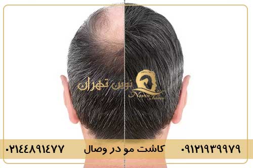 کاشت مو در وصال