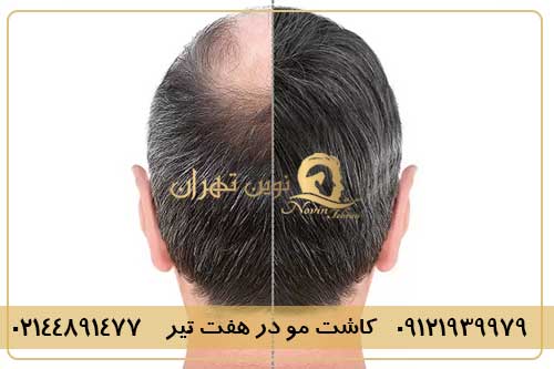 کاشت مو در هفت تیر