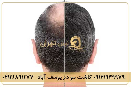 کاشت مو در یوسف آباد