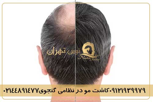 کاشت مو در نظامی گنجوی